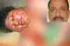 UP: SP MLA sets woman on fire, flees
